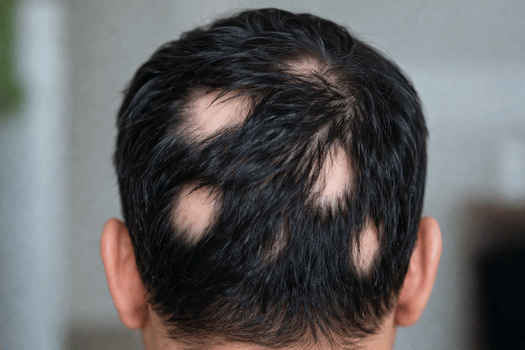 Termal Su Saçkırana İyi Gelir mi?