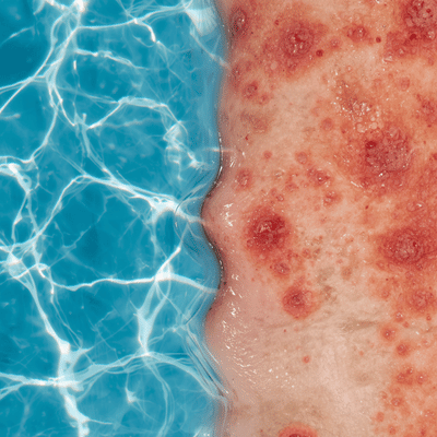 termal suyun sedefe etkisi